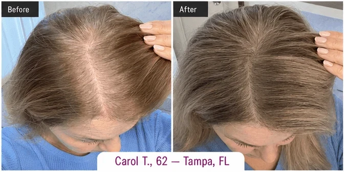 Carol, 62, shown in one matched before-and-after part-line comparison